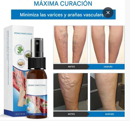 ¡Dile adiós a las venas varicosas y recupera tu bienestar!  PROMO PAGA 1 LLEVA 2